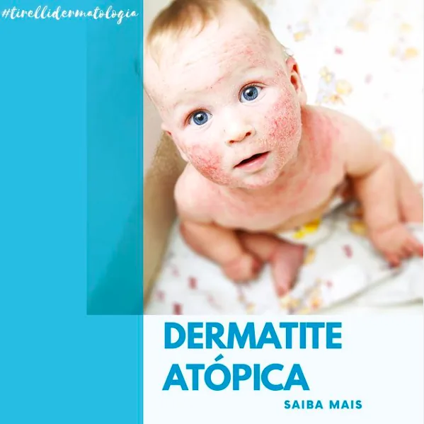 Arte de divulgação azul com a foto de um bebê com lesões de dermatite atópica no rosto